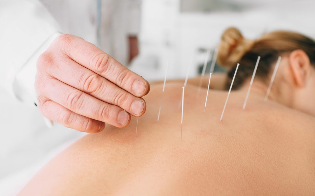 Embrace a Pain-Free Life: The Role of Acupuncture in Pain Management